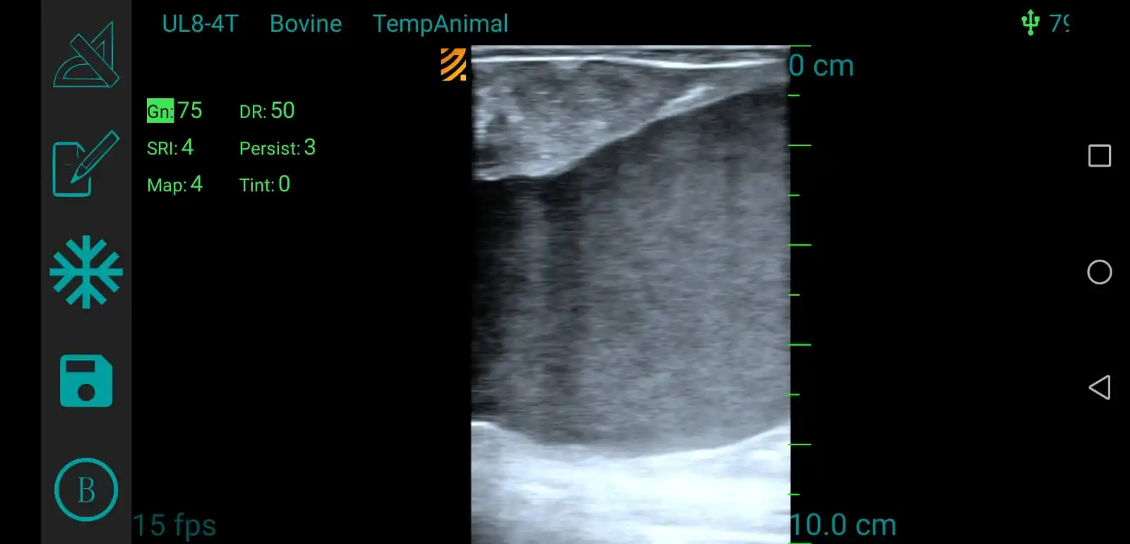 Endometriosis.jpeg