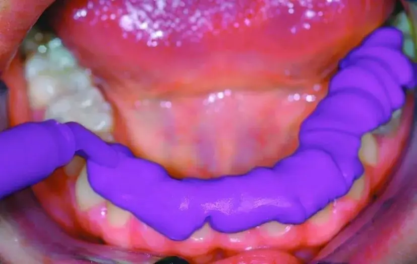 bite2