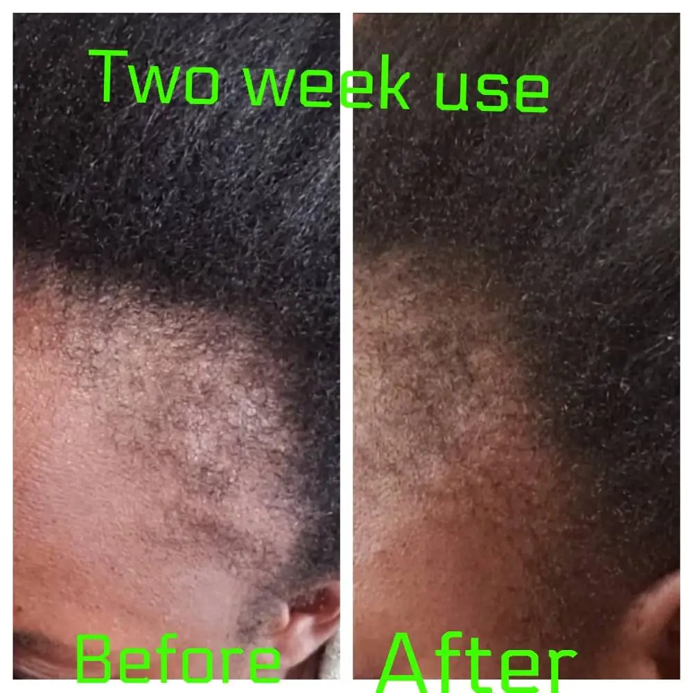 Оптовая продажа, Фирменное масло для роста волос для мужчин и женщин, лечение облысения без побочного эффекта, 100 мл