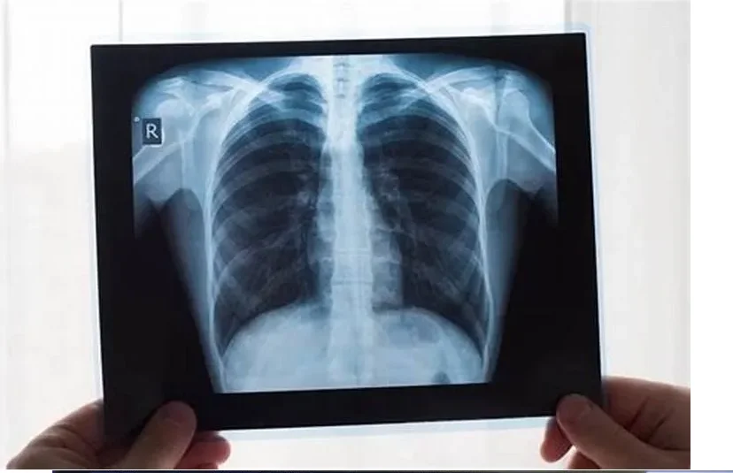 125 Micron Semi Transparent White Color Semi Transparent Laser Medical X-ray Plastic Pet Films For Medical Used