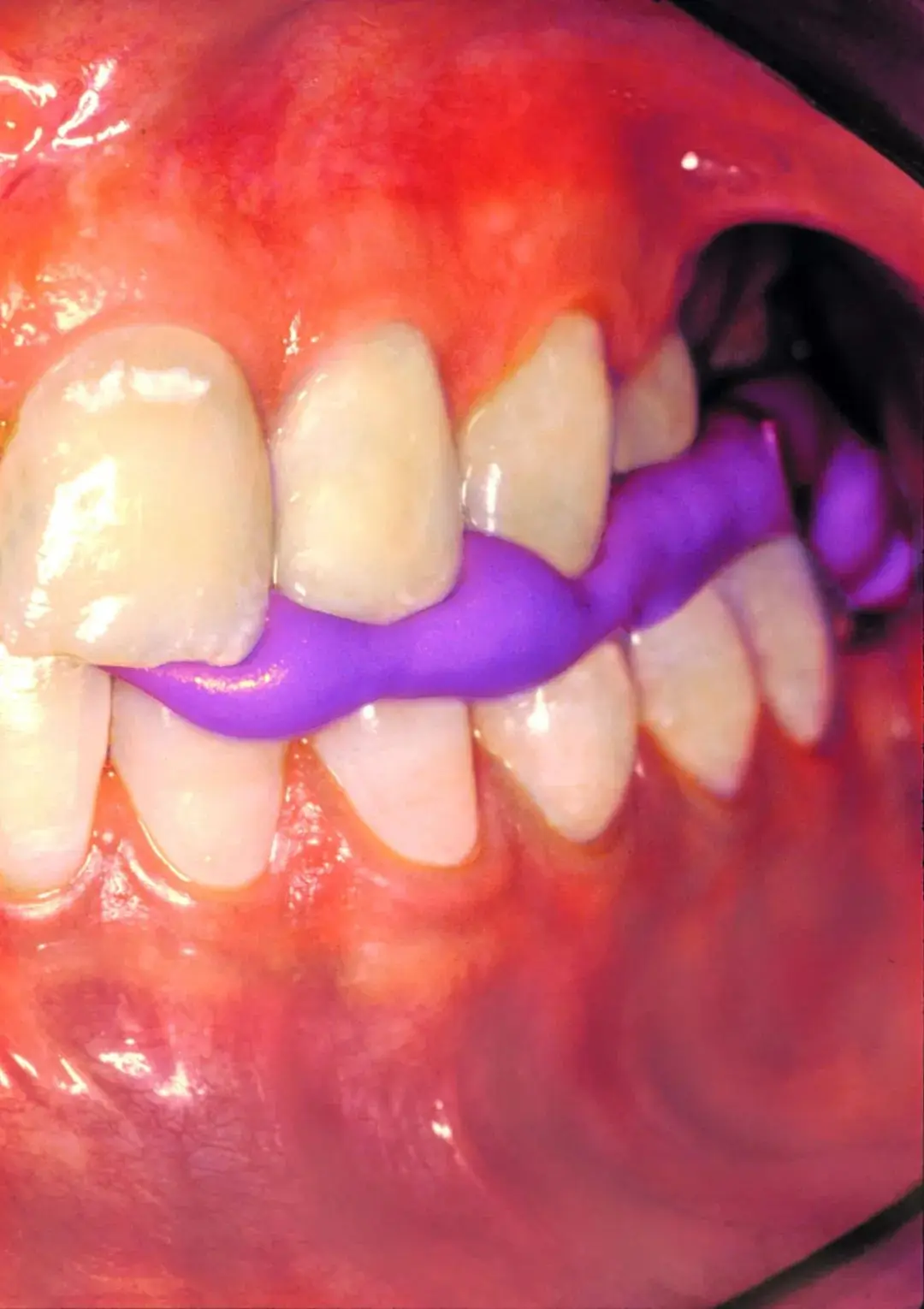 bite 3