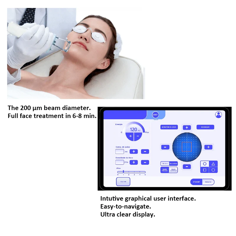 2024 new Rapid treatment 200 μm beam diameter nonablative factional For laser treatment of wrinkles1927nm thulium laser machine
