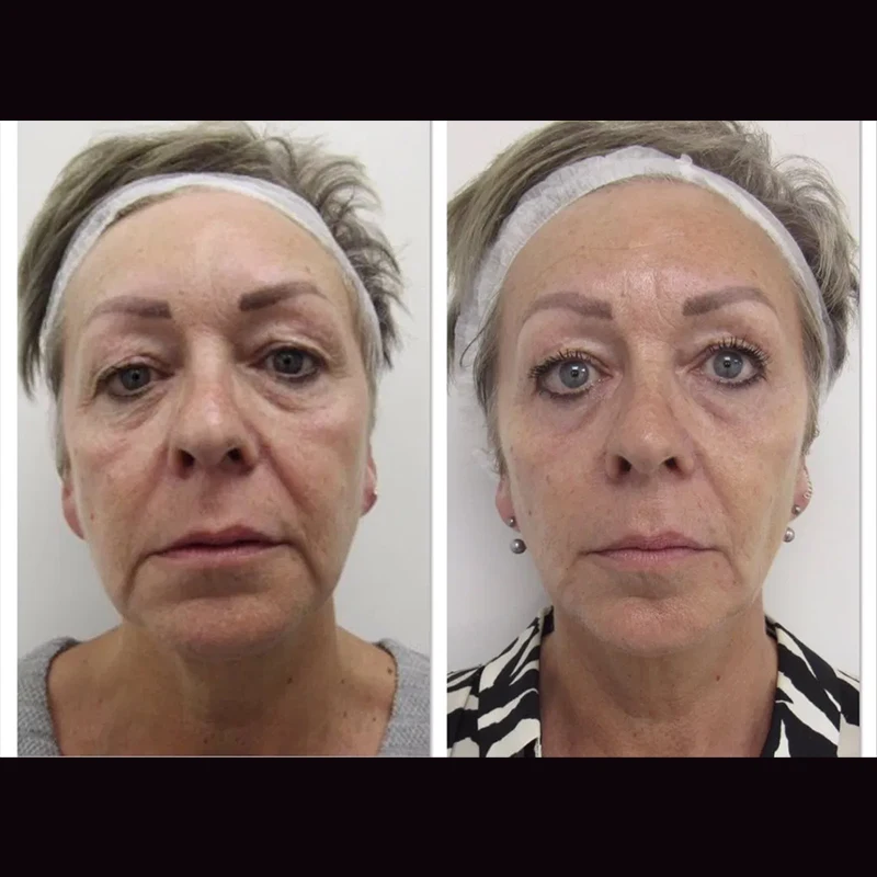 Beauty skin care barbed cog facial tensor threads medical suture face nose  v lifting mono 26g 90mm pdo thread