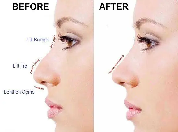 Heremefill Cross-Linked Hyaluronic Acid Dermal Filler Body Nose Face Lip Enhancement Fillers