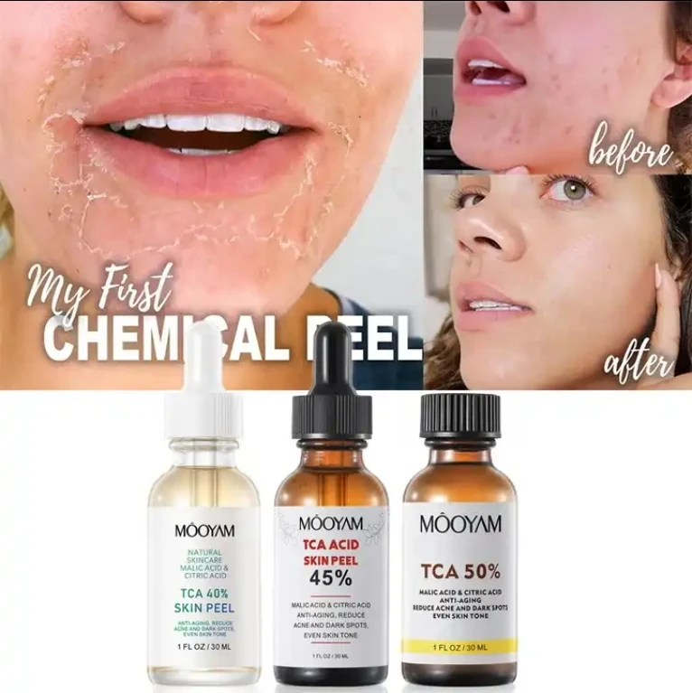 Skin TCA 40% 45% 50% Chemical Peel Professional Chemical Peel Serum For Skin Dark Spot Remover