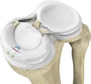 ARTOFIX MENISCAL  REPAIR SYSTEM ALL INSIDE - EXPERT MANUFACTURER IN ARTROSCOPIC SURGERY - NEOSYS