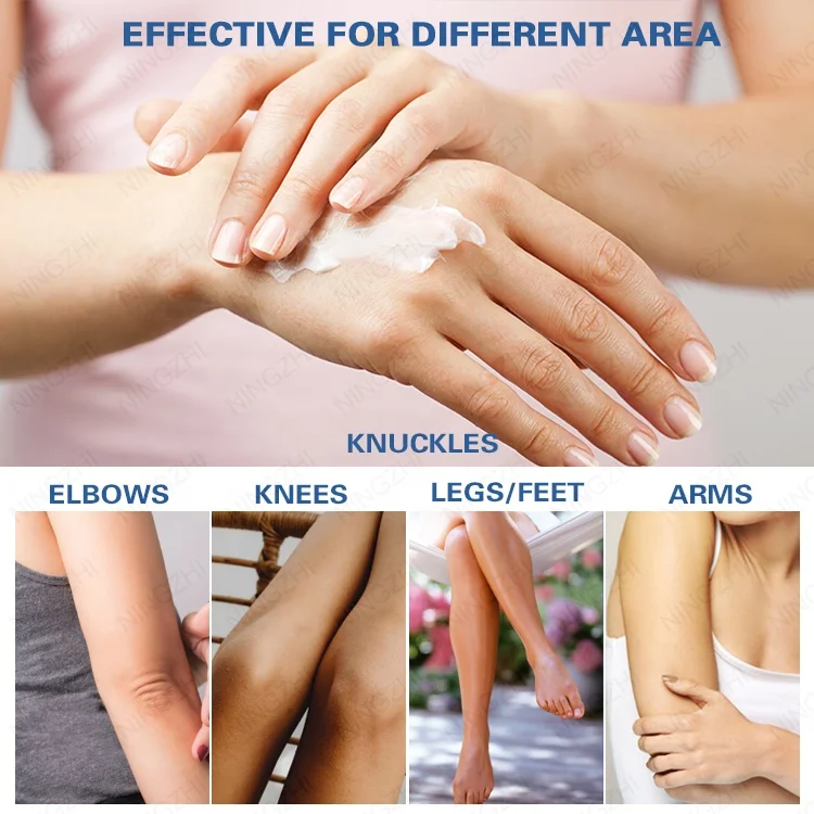 Hot sale best dark spot corrector cream lightening whitening dark knuckle elbows knees eraser cream