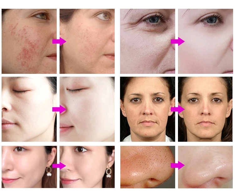 h2O2 hydro water jet peel  hydrodermabrasion device 7 en 1 facial dermabrasion hydra microdermabrasion machine