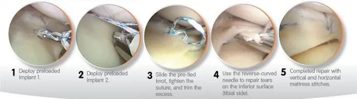 NEOSYS MENISCAL REPAIR SYSTEM - Clinically proven in the repair of meniscal tears-with a 20 year heritage of treatment success