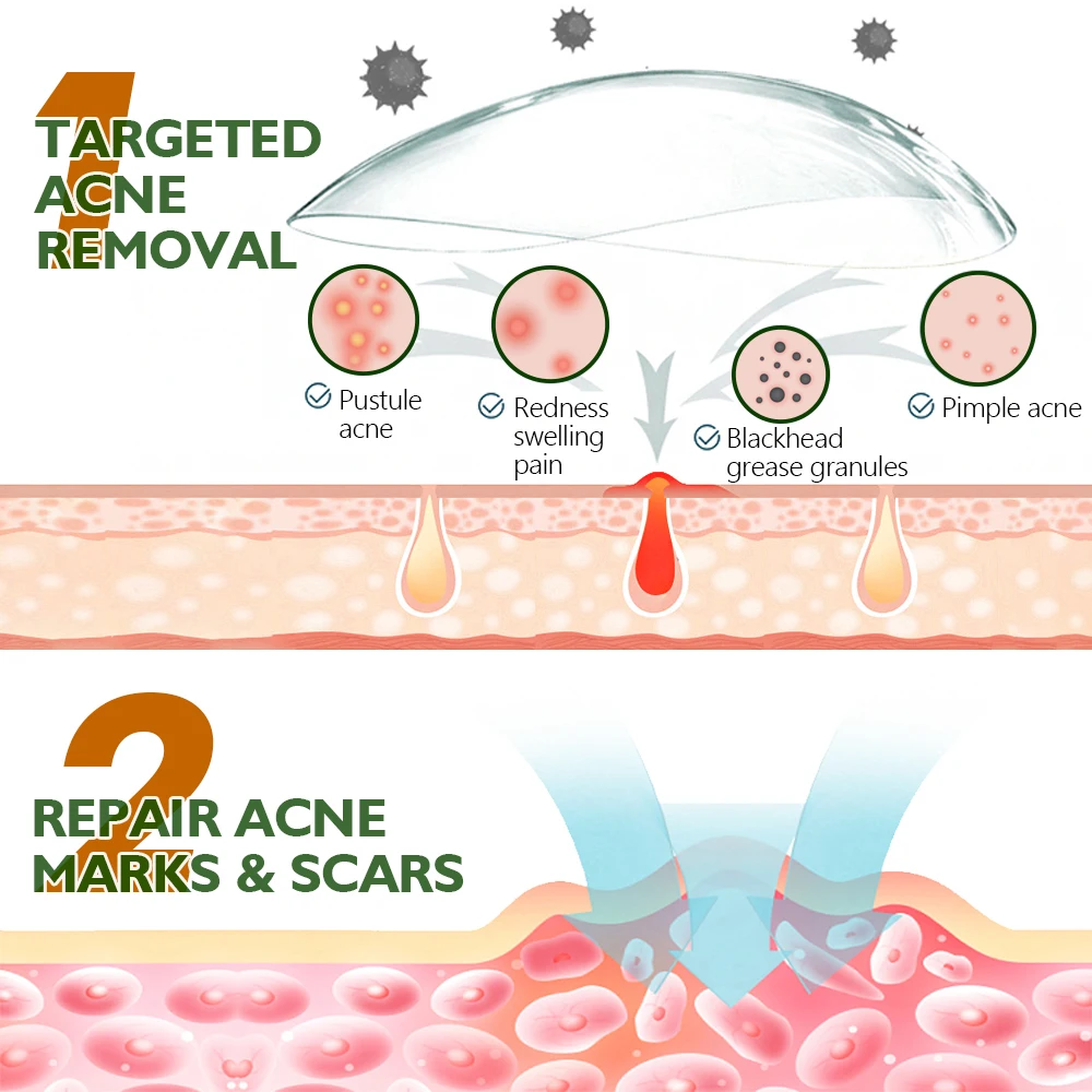 Acne Treatment Serum Private Label Acne Spot Serum Treatment Skin Care Acne Treatment Face Serum