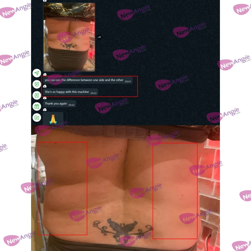 Newangie 6 in 1 7d hifu frctional rf microneedle facial and body ultrasound hifu vaginal tightening anti wrinkles machine