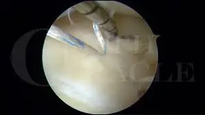 ARTOFIX MENISCAL  REPAIR SYSTEM ALL INSIDE - EXPERT MANUFACTURER IN ARTROSCOPIC SURGERY - NEOSYS