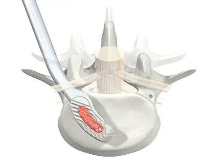 Sm-444 Medical Surgery Implant PEEK TLIF Steel Cage Posterior Lumbar Interbody Fusion System CE Certified 1-Year Warranty Online