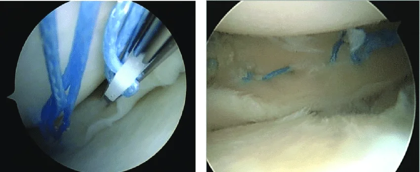 NEOSYS MENISCAL REPAIR SYSTEM - Clinically proven in the repair of meniscal tears-with a 20 year heritage of treatment success