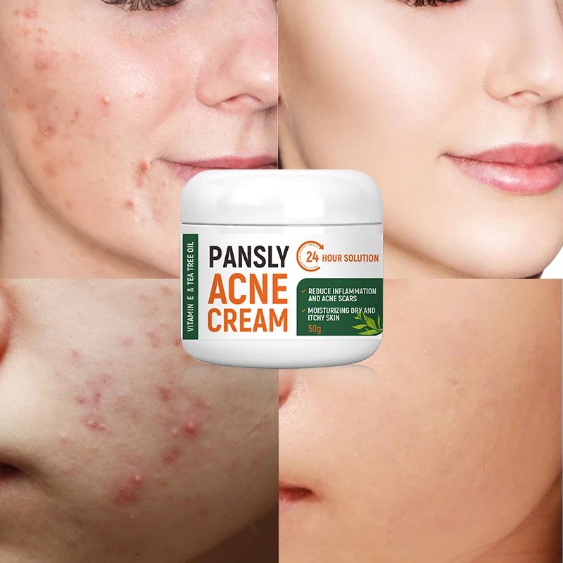 Pansly organic Whitening Treatment Removal Acne Gel anti-aging Salicylic Acid Herbal Skin Care Tea Tree Oil face Cream