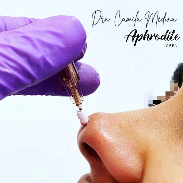 KOREA MANUFACTURED CE ISO APPROVED NOSE LIFT THREAD PDO PLACL (PCL + PLLA) Strong and instant nose job for nasal tip and bridge