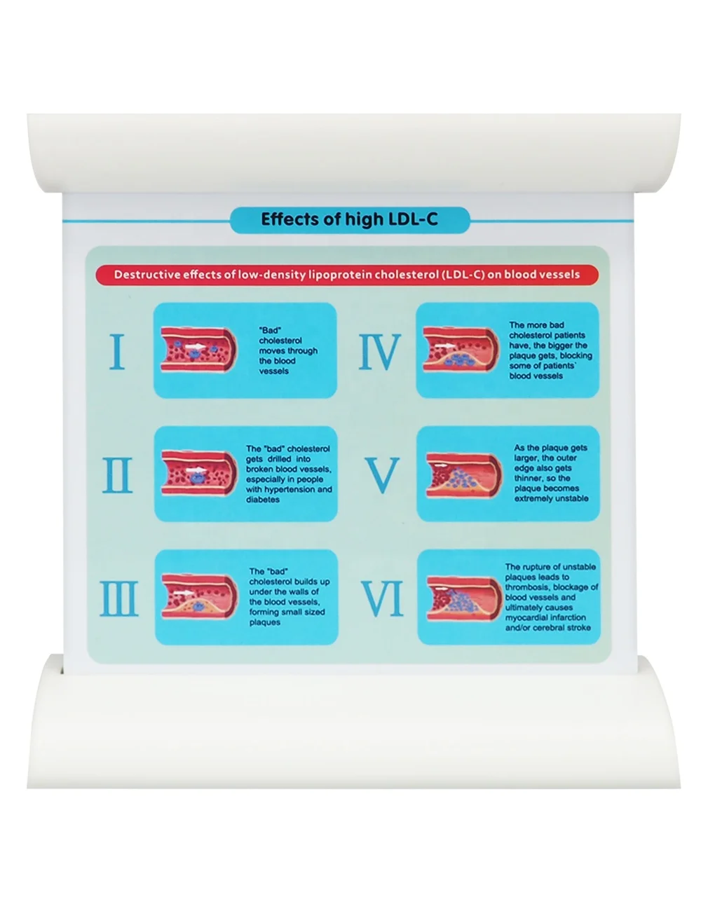 Thrombosis Model Vascular Disease Pathology Demonstration Dynamic Low-Density Lipoprotein LDL Blood Vessel Model