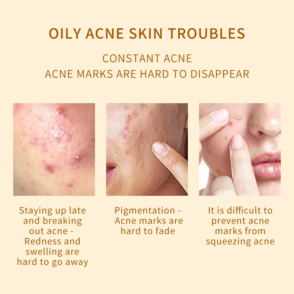 OEM ODM Acne Dark Spot Remover Plant Extract Herbal Face Serum 50g Whitening Fruit Acid Acne Serum For Pimples And Acne