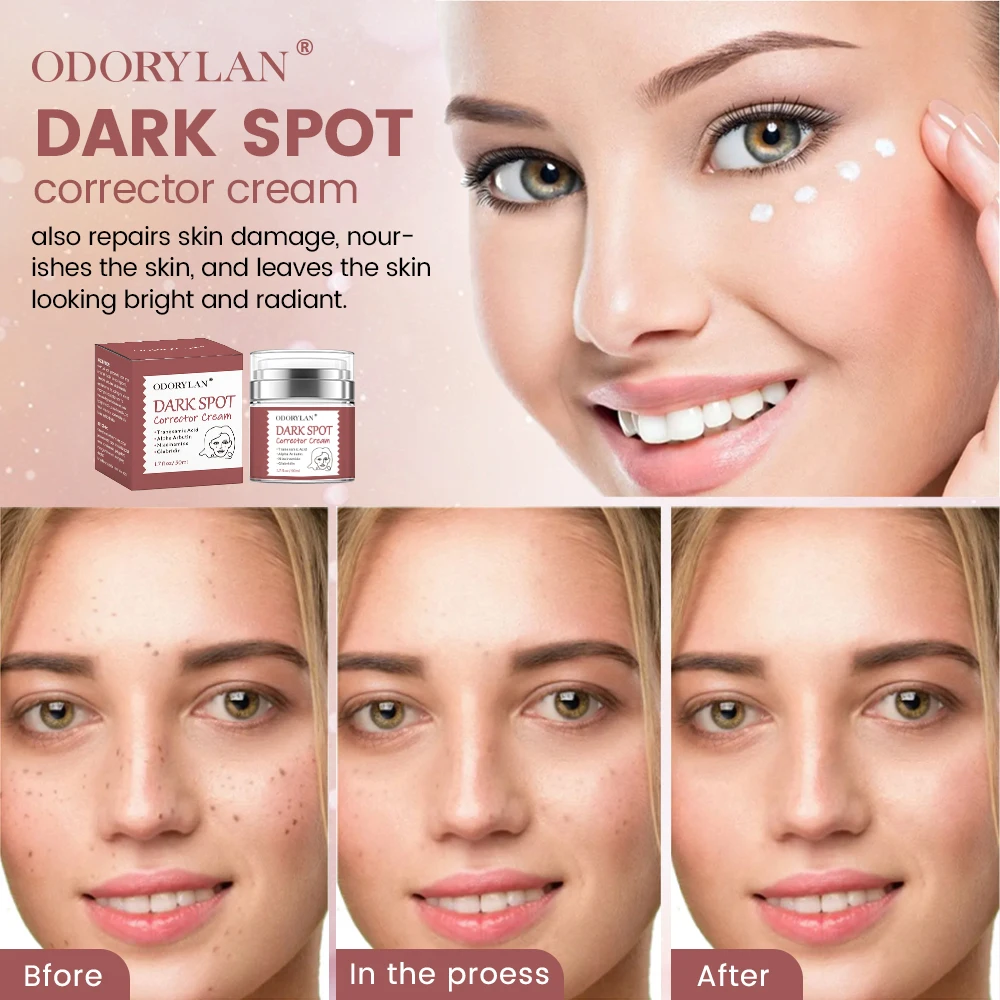 wholesale whitening pimples acne scar treatment freckle dark spot corrector removing fade cream