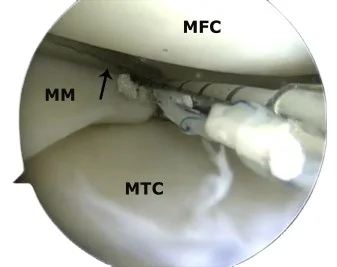 NEOSYS MENISCAL REPAIR SYSTEM - Clinically proven in the repair of meniscal tears-with a 20 year heritage of treatment success