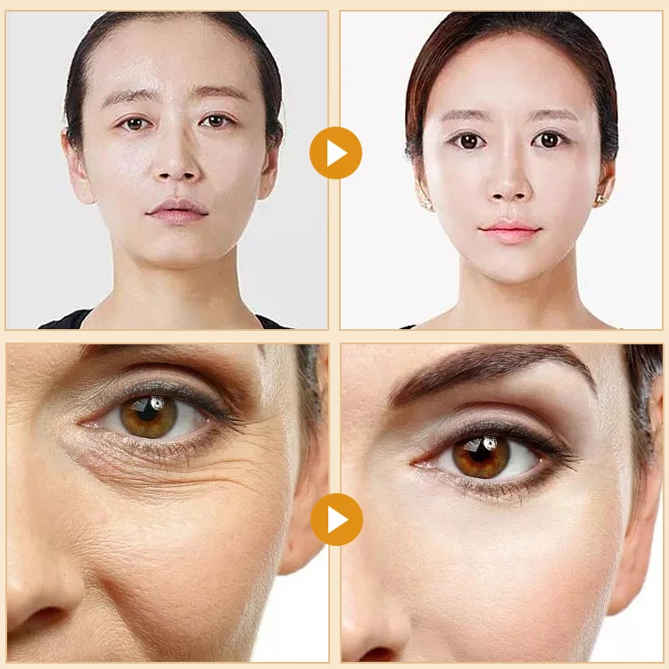 Hot Sale Water Soluble Collagen Line Facial Care Face Lift Line Anti-Wrinkle Gold Protein Peptide and Lift Thread