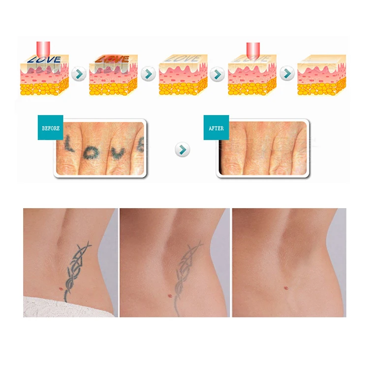 professional tattoo removal device carbon peel laser q switched nd yag laser