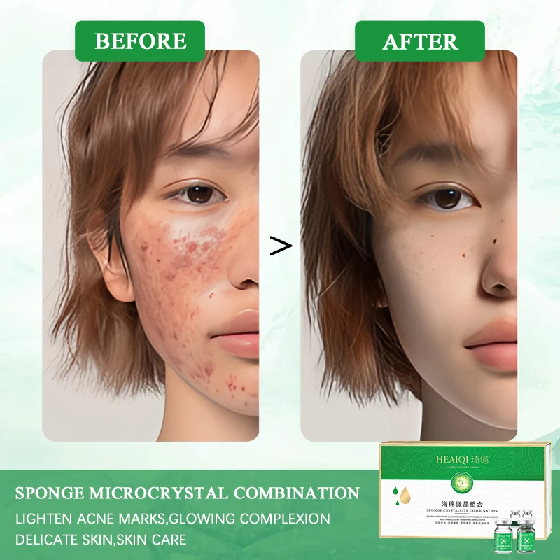 acne removal sponge spicule bio microneedling microcrystalline cellulose powder,lyophilized freeze dried powder mud mask set