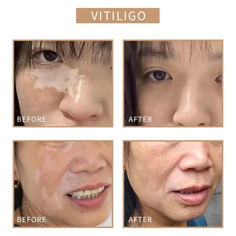 Tattoo Permanent Microblading Pigments Dark Knee Removal Camouflage Tattoo Scar Ink