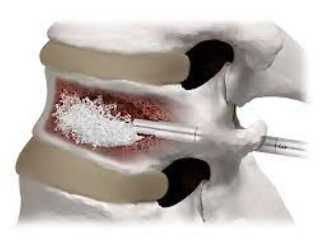 Bone Cement Radiopaque High Viscosity for Ortho 40 gr PMMA  polymethyl methacrylate Sterile Surgical  acrylic  best selling