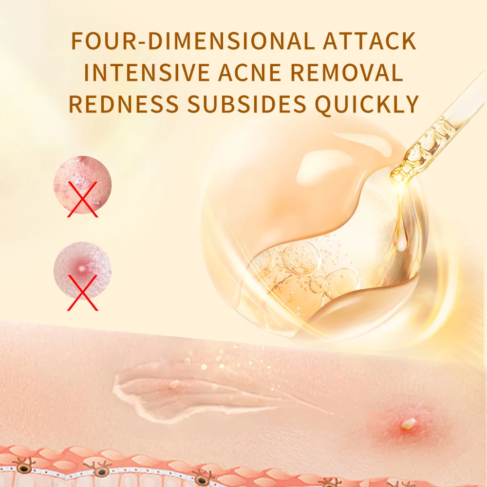 OEM ODM Acne Dark Spot Remover Plant Extract Herbal Face Serum 50g Whitening Fruit Acid Acne Serum For Pimples And Acne