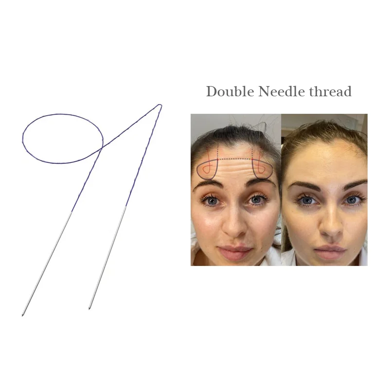 ce certificate face tightening medical suture facial v shaping twin thread lifting pdo double needle