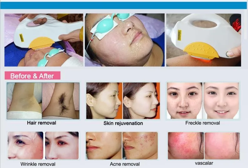 2024 Beauty professional salon equipment skin rejuvenation ipl laser hair removal machine  for sale