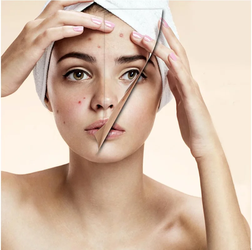 AKNICARE Lotion /  Acne prone skin