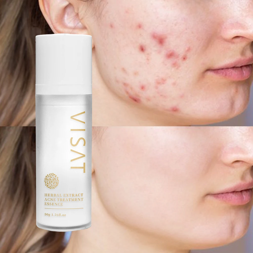 OEM ODM Acne Dark Spot Remover Plant Extract Herbal Face Serum 50g Whitening Fruit Acid Acne Serum For Pimples And Acne