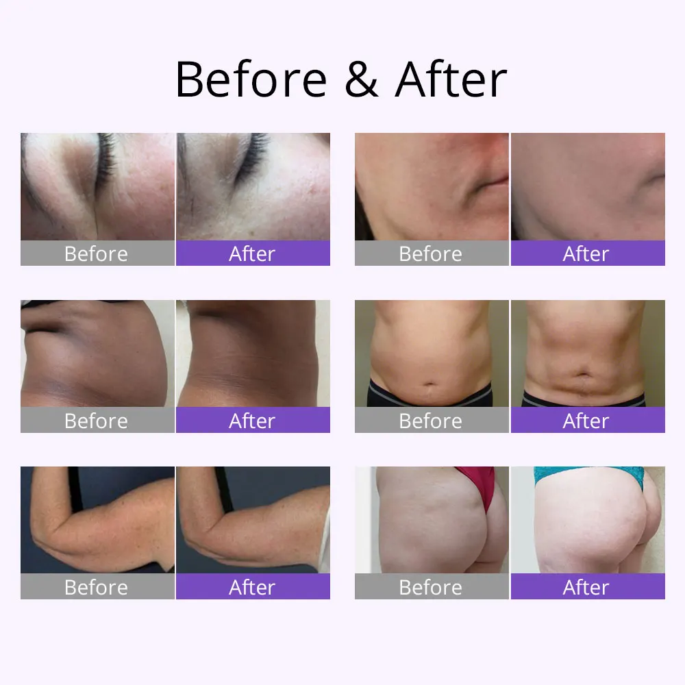 S-SHAPE EMS Electroporation Vacuum Suction Body Face Care Cavi Machine