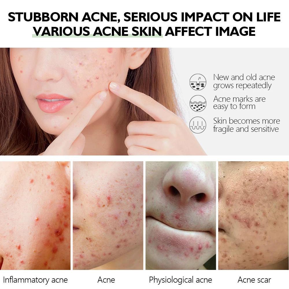 Acne Treatment Serum Private Label Acne Spot Serum Treatment Skin Care Acne Treatment Face Serum