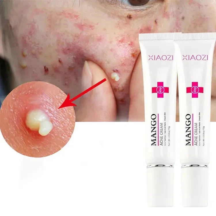 Multi effect face anti-acne cream scar removal best pimples acne removing cream for ance
