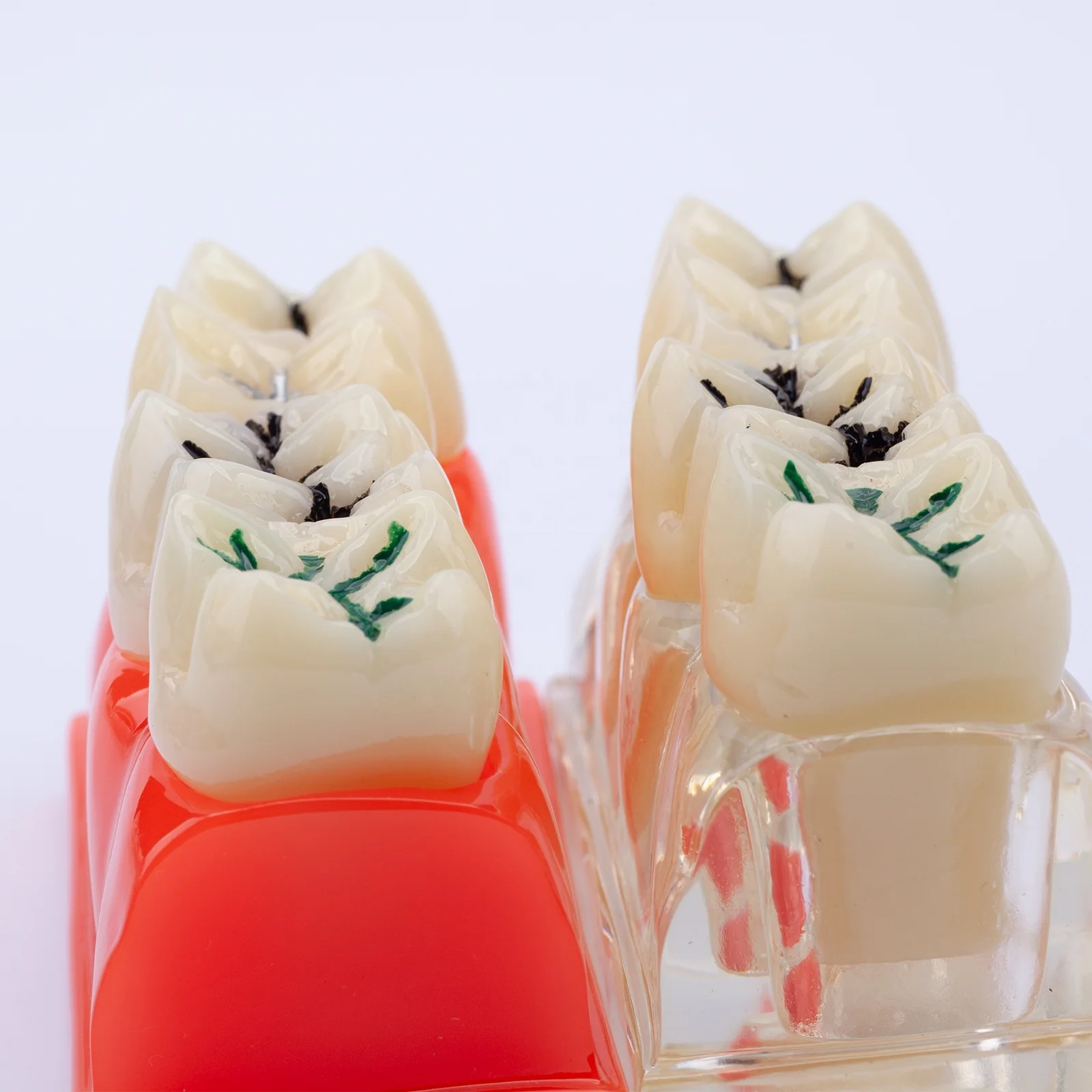 Pit and Fissure Sealant Teeth Model Demonstration Dental Model for for Patients Communication and Education