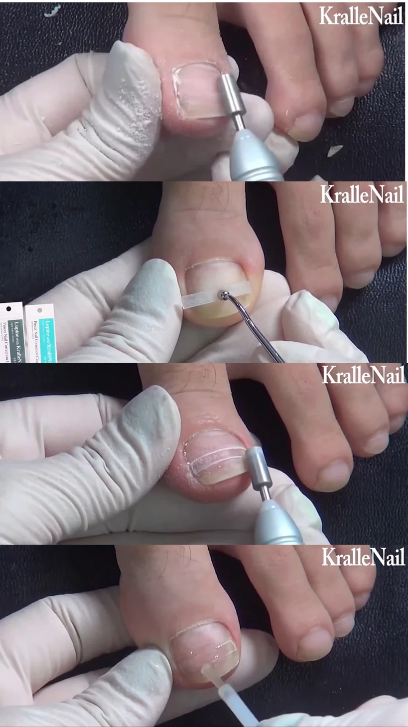 Dr. Kralle hurtless nail kit for ingrown toenail Korean curved toenail corrector simple to use safety and direct effect
