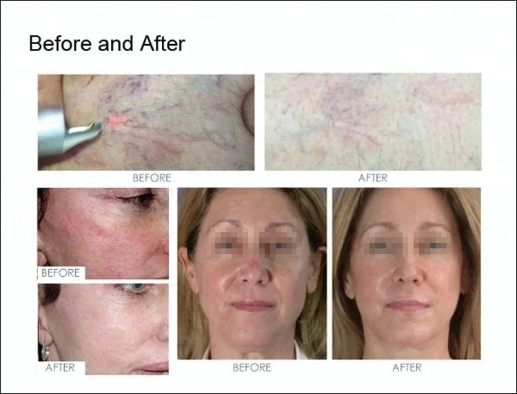 2024 Newest adss 980nm diode laser vascular removal machine