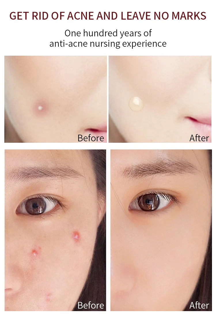 Prival Label Acne Patch for Acne Pimple Patch  Whitehead Absorbing Custom Skin Care Face Purifying Pores