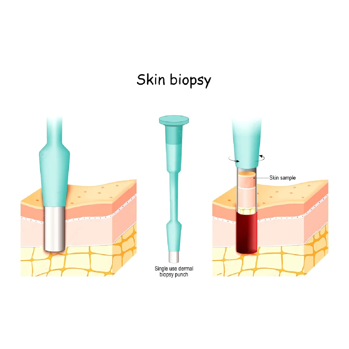 Biopsy Punch Disposable Sterile 1mm to 8mm