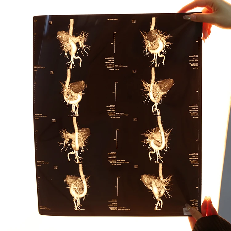 Medical Dry Imaging Film For DR CT MRI DSA High Solution Pet Blue Dry Thermal Medical Film