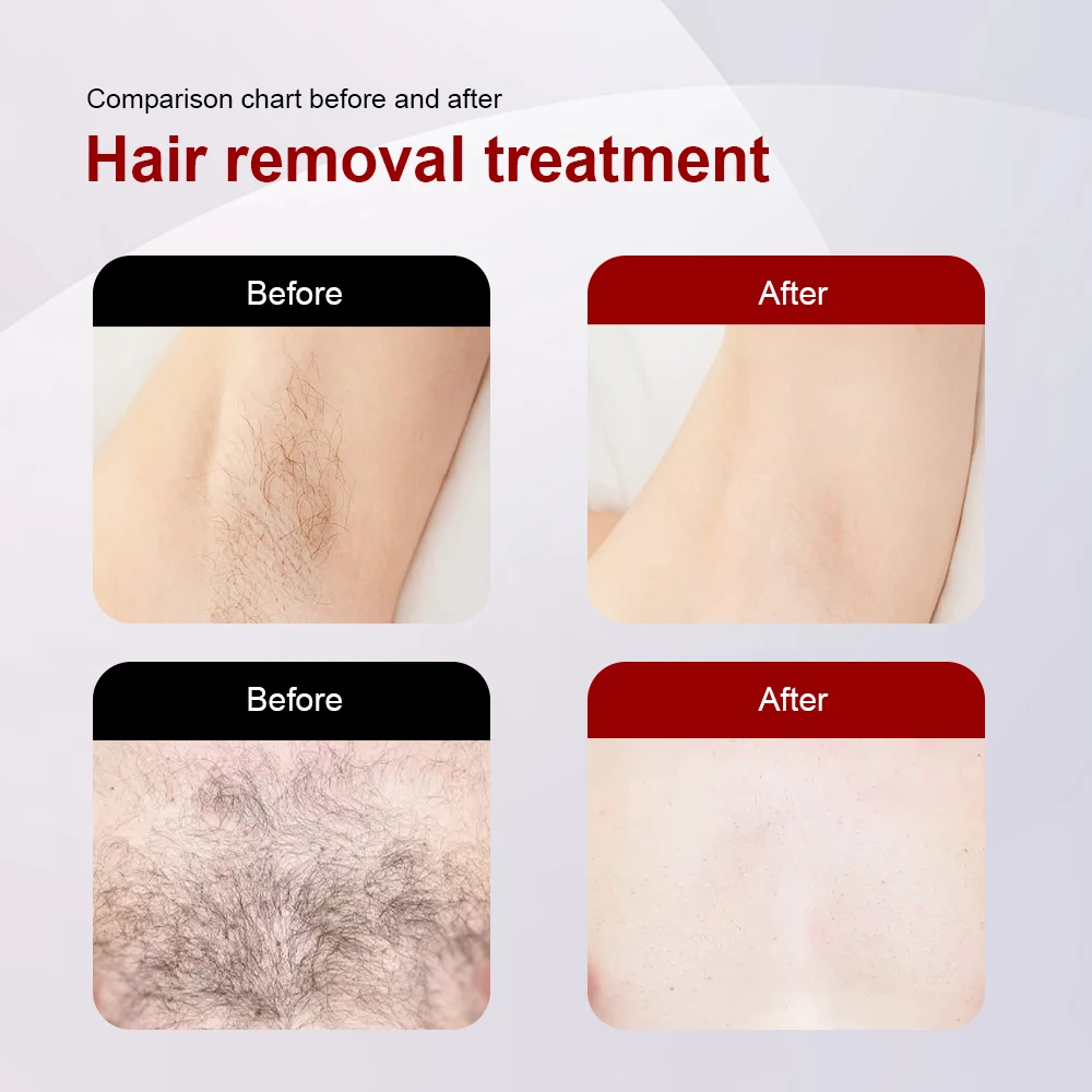 The Cloud era 2023 switchable spot Ice titanium 4K diode laser epilator alexandrite triple laser hair removal machine