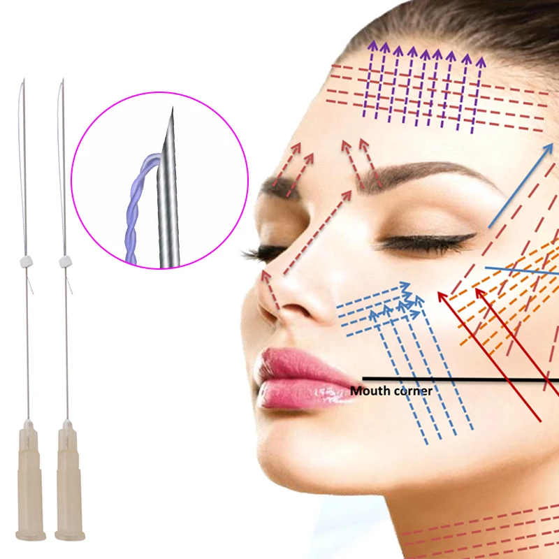 high quality korea nasolabial folds face lift 26g 38mm 60mm models facial lifting tornado pdo thread