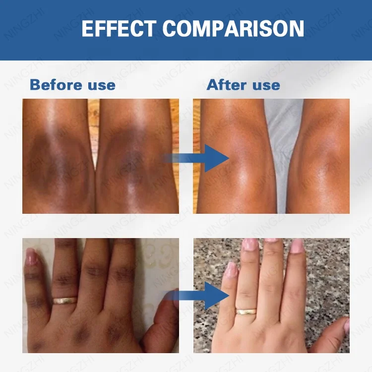 Hot sale best dark spot corrector cream lightening whitening dark knuckle elbows knees eraser cream