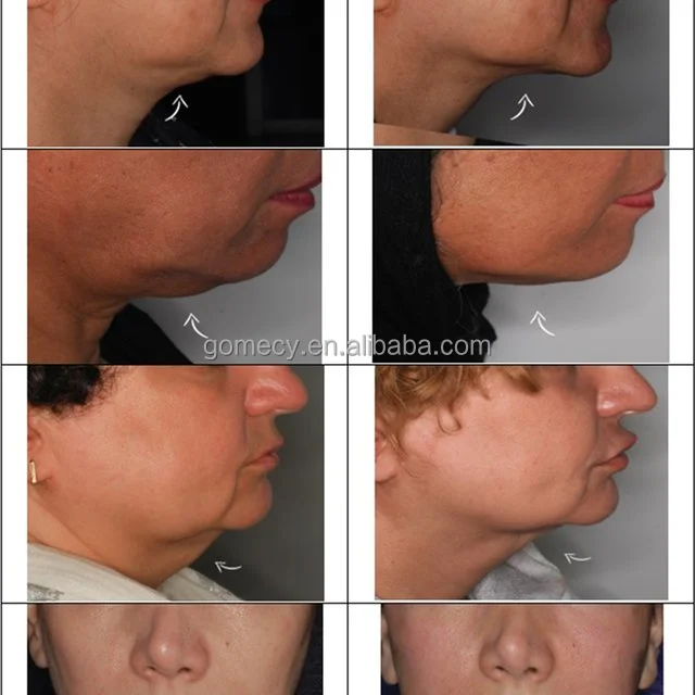 2024-Top-Sales-Most-Effective-Skin-Rejuvenation-Endolaser-Diode-Liposuction-Equipment-980-Nm-1470-
