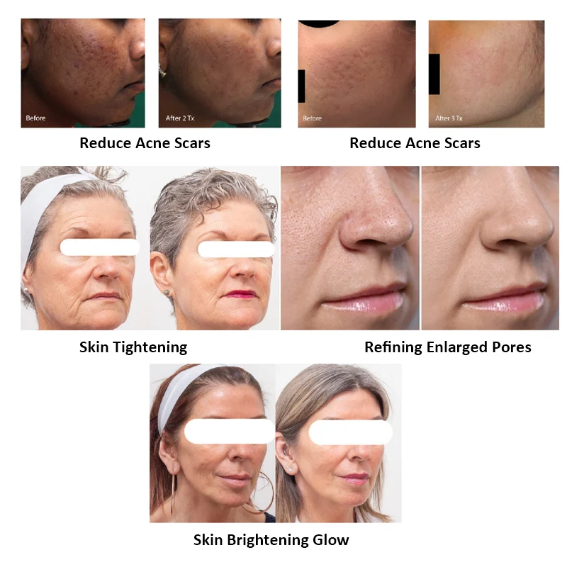 2024 new Rapid treatment 200 μm beam diameter nonablative factional For laser treatment of wrinkles1927nm thulium laser machine