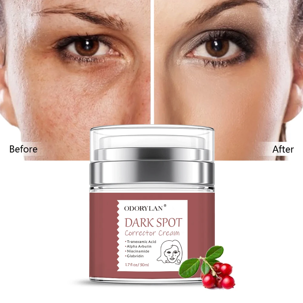 wholesale whitening pimples acne scar treatment freckle dark spot corrector removing fade cream