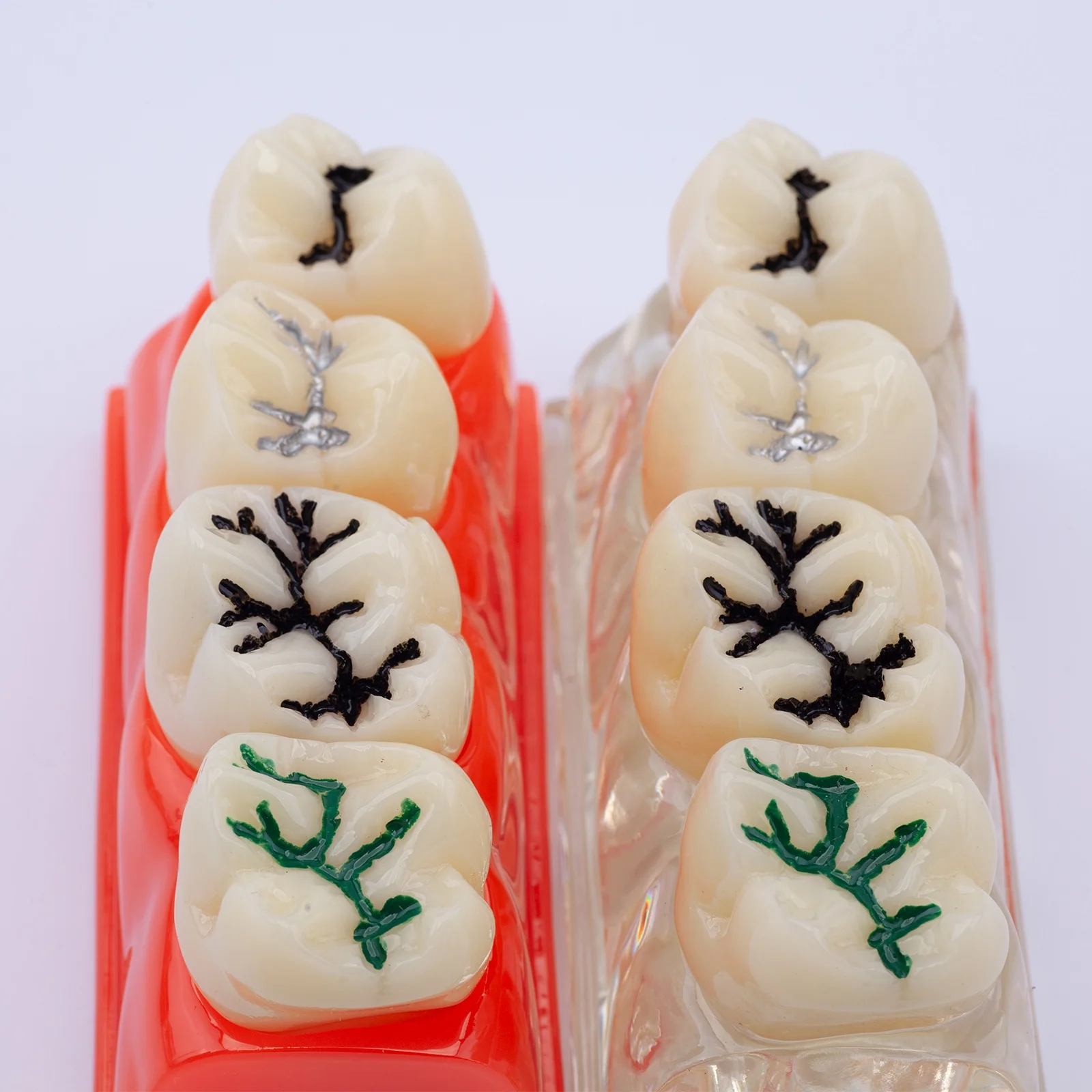 Pit and Fissure Sealant Teeth Model Demonstration Dental Model for for Patients Communication and Education